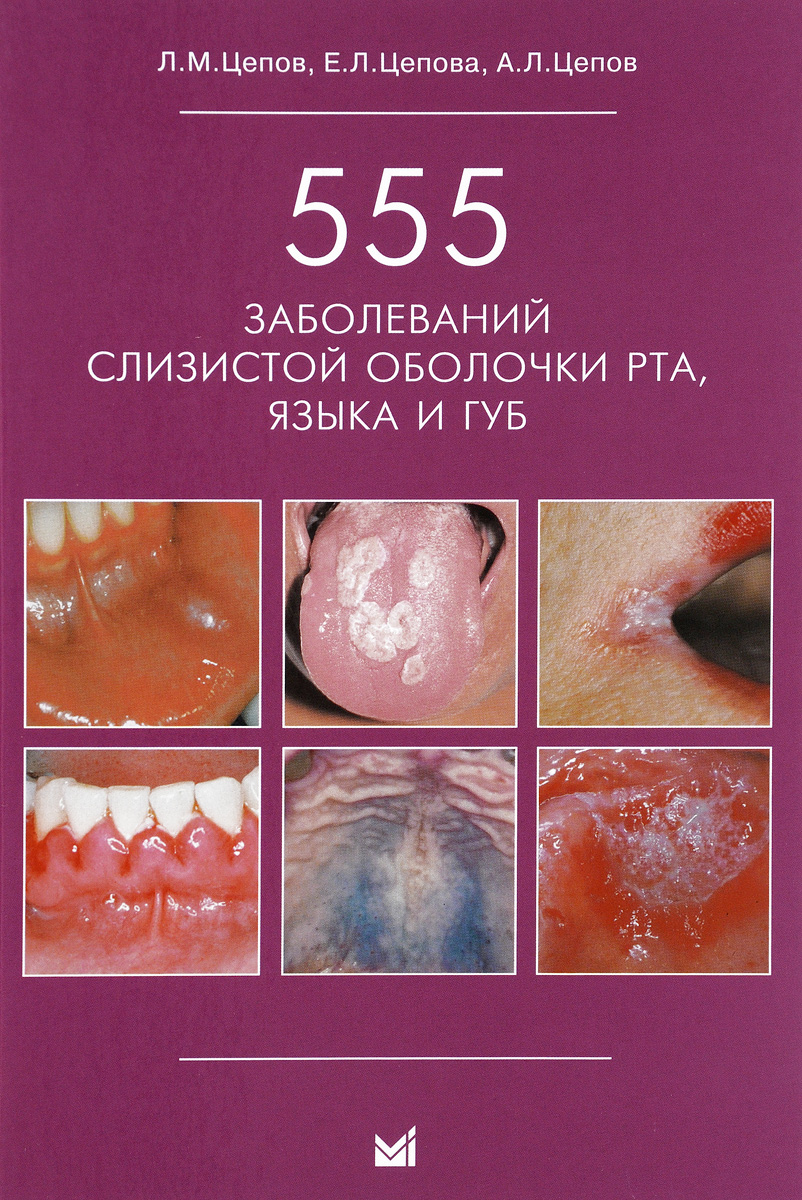 555 заболеваний слизистой оболочки рта, языка и губ. Л. М. Цепов, Е. Л. Цепова, А. Л. Цепов
