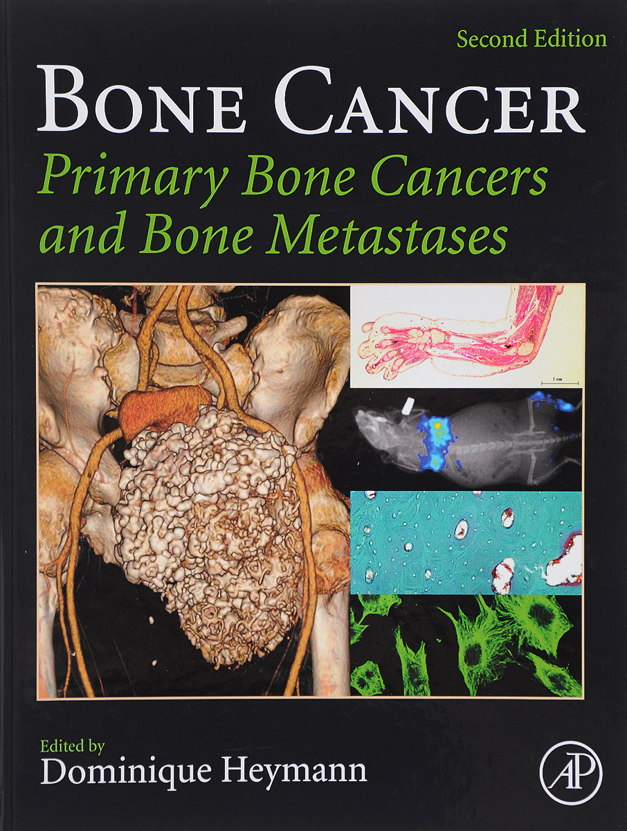 Bone Cancer: Primary Bone Cancers and Bone Metastases art of bone